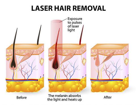 SkinPure Laser Hair Remover